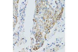 Immunohistochemistry of paraffin-embedded human lung cancer using SIRT2 antibody (ABIN5970103) at dilution of 1/100 (40x lens). (SIRT2 Antikörper)