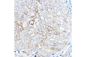 Immunohistochemistry of paraffin-embedded human breast cancer using TMPRSS2 Rabbit pAb (ABIN6132728, ABIN6149286, ABIN6149287 and ABIN6219138) at dilution of 1:50 (40x lens).