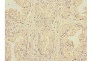 Immunohistochemistry of paraffin-embedded human prostate cancer using ABIN7161113 at dilution of 1:100 (nectin-3 Antikörper  (AA 310-549))