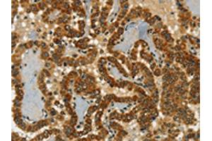 The image on the left is immunohistochemistry of paraffin-embedded Human thyroid cancer tissue using ABIN7190246(CHRDL2 Antibody) at dilution 1/20, on the right is treated with synthetic peptide. (CHRDL2 Antikörper)