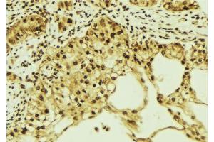 ABIN6276850 at 1/100 staining Human breast cancer tissue by IHC-P.