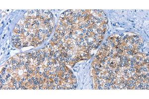 Immunohistochemistry of paraffin-embedded Human prostate cancer using CD239 Polyclonal Antibody at dilution of 1:40 (BCAM Antikörper)