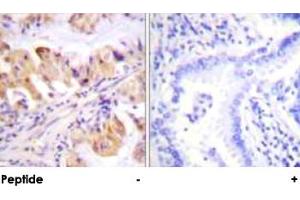 Immunohistochemical analysis of paraffin-embedded human lung carcinoma tissue using PTGES3 polyclonal antibody . (PTGES3 Antikörper  (Ser113))