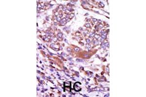 Formalin-fixed and paraffin-embedded human hepatocellular carcinoma tissue reacted with CAMK2D polyclonal antibody  , which was peroxidase-conjugated to the secondary antibody, followed by AEC staining. (CAMK2D Antikörper  (C-Term))