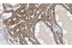 ABIN6269117 at 1/100 staining Human liver cancer tissue by IHC-P.