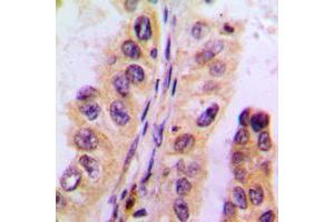 Immunohistochemical analysis of Cytochrome P450 3A4/5 staining in human liver cancer formalin fixed paraffin embedded tissue section. (Cytochrome P450 3A4, 3A5 (Center) Antikörper)