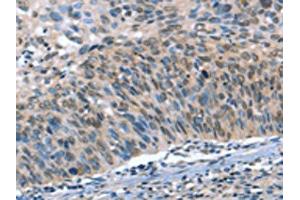The image on the left is immunohistochemistry of paraffin-embedded Human cervical cancer tissue using ABIN7190052(CAMTA1 Antibody) at dilution 1/15, on the right is treated with synthetic peptide. (CAMTA1 Antikörper)