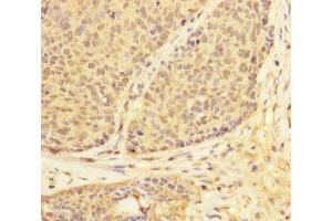 Immunohistochemistry of paraffin-embedded human ovarian cancer using ABIN7174303 at dilution of 1:100