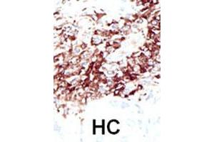 Formalin-fixed and paraffin-embedded human hepatocellular carcinoma tissue reacted with the HDAC11 polyclonal antibody  , which was peroxidase-conjugated to the secondary antibody, followed by DAB staining. (HDAC11 Antikörper  (N-Term))