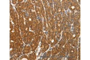 Immunohistochemistry of Human thyroid cancer using PTCH1 Polyclonal Antibody at dilution of 1:50 (Patched 1 Antikörper)