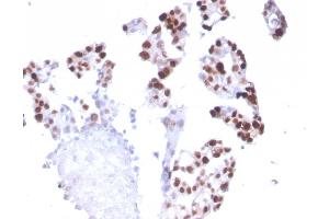 Formalin-fixed, paraffin-embedded human Breast Carcinoma stained with RNA Polymerase II / Poll II Mouse Monoclonal Antibody (CTD4H8). (POLR2A/RPB1 Antikörper  (pSer5))