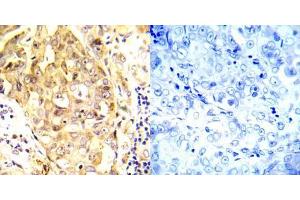 Immunohistochemical analysis of paraffin- embedded human breast carcinoma tissue using P53 (Ab-20) antibody (E022030). (p53 Antikörper)