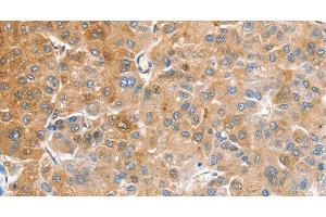 Immunohistochemistry of paraffin-embedded Human liver cancer tissue using CDR2 Polyclonal Antibody at dilution 1:60 (CDR2 Antikörper)