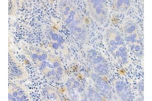 ABIN6260336 and ABIN6269094 at 1/100 staining human colon carcinoma by IHC-P.