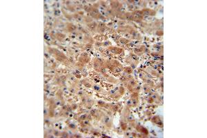ASAP3 antibody immunohistochemistry analysis in formalin fixed and paraffin embedded human hepatocarcinoma followed by peroxidase conjugation of the secondary antibody and DAB staining. (ASAP3 Antikörper  (N-Term))