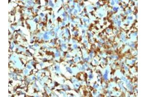 Immunohistochemical staining (Formalin-fixed paraffin-embedded sections) of human histiocytoma with F13A1 monoclonal antibody, clone F13A1/1448 . (F13A1 Antikörper  (AA 46-181))