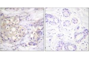 Immunohistochemistry analysis of paraffin-embedded human breast carcinoma, using PKC alpha (Phospho-Thr638) Antibody. (PKC alpha Antikörper  (pThr638))