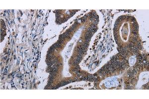 Immunohistochemistry of paraffin-embedded Human ovarian cancer tissue using ITGAE Polyclonal Antibody at dilution of 1:50 (CD103 Antikörper)