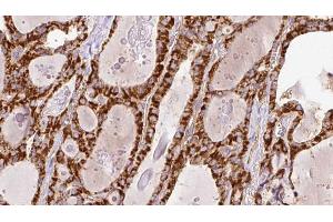 ABIN6266447 at 1/100 staining Human thyroid cancer tissue by IHC-P. (RYR2 Antikörper  (Internal Region))