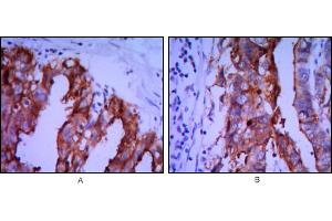 Immunohistochemical analysis of paraffin-embedded ovarian cancer (A), stomach cancer (B) using ALPP mouse mAb with DAB staining. (PLAP Antikörper)