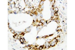 IHC-P: MEK3 antibody testing of human breast cancer tissue