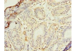 Immunohistochemistry of paraffin-embedded human breast cancer using ABIN7175174 at dilution of 1:100 (RAD23B Antikörper  (AA 1-250))