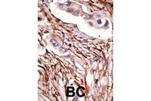 Formalin-fixed and paraffin-embedded human breast cancer tissue reacted with NOTCH3 polyclonal antibody  , which was peroxidase-conjugated to the secondary antibody, followed by DAB staining. (NOTCH3 Antikörper  (C-Term))