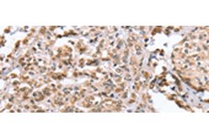 Immunohistochemistry of paraffin-embedded Human prost at e cancer tissue using ZFYVE16 Polyclonal Antibody at dilution of 1:60(x200) (ZFYVE16 Antikörper)