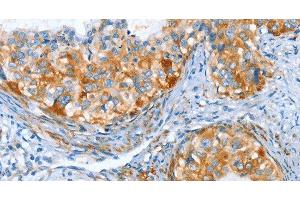 Immunohistochemistry of paraffin-embedded Human cervical cancer tissue using AIP Polyclonal Antibody at dilution 1:80 (AIP Antikörper)