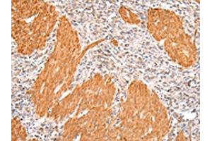 The image on the left is immunohistochemistry of paraffin-embedded Human gastric cancer tissue using ABIN7191067(IKZF4 Antibody) at dilution 1/20, on the right is treated with synthetic peptide. (IKZF4 Antikörper)