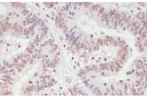 Immunohistochemistry of paraffin-embedded Human colon carcinoma using SNRNP70 Polyclonal Antibody at dilution of 1:100 (40x lens).