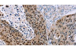 Immunohistochemistry of paraffin-embedded Human esophagus cancer using MAGEA10 Polyclonal Antibody at dilution of 1:30
