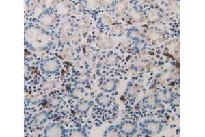IHC-P analysis of stomach cancer tissue, with DAB staining. (Midkine Antikörper  (AA 22-143))