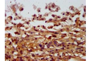 IHC image of ABIN7148018 diluted at 1:400 and staining in paraffin-embedded human melanoma performed on a Leica BondTM system. (COPG2 Antikörper  (AA 676-823))