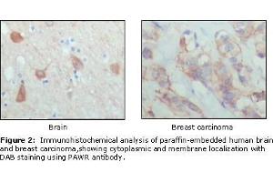 Immunohistochemical analysis of paraffin-embedded human brain (left) and breast carcinoma (right), showing cytoplasmic and membrane localization using PAR4 antibody with DAB staining. (F2RL3 Antikörper  (AA 1-330))