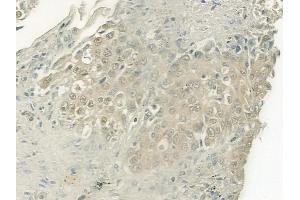 ABIN6264131 and ABIN6277486 at 1/100 staining human lung squamous cell carcinoma by IHC-P. (PELP1 Antikörper  (Internal Region))