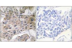 Immunohistochemistry analysis of paraffin-embedded human breast carcinoma tissue, using COX7S/A2 Antibody. (COX7S/A2 (AA 1-50) Antikörper)