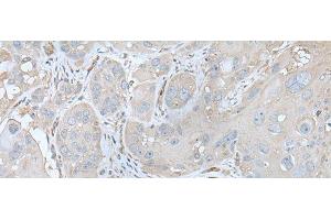 Immunohistochemistry of paraffin-embedded Human esophagus cancer tissue using USO1 Polyclonal Antibody at dilution of 1:30(x200) (USO1 Antikörper)