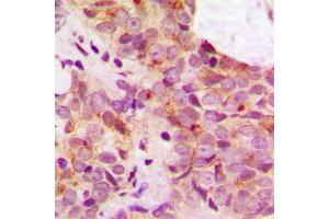 Immunohistochemical analysis of TAU (pS356) staining in human breast cancer formalin fixed paraffin embedded tissue section.
