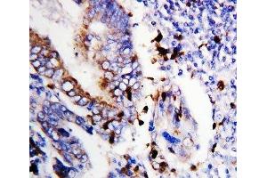 IHC-P: Bcl-XS antibody testing of human colon cancer tissue (Bcl-X/s (AA 120-130) Antikörper)