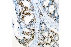 Immunohistochemical analysis of CDK2 staining in human colon cancer formalin fixed paraffin embedded tissue section. (CDK2 Antikörper  (Center))