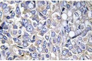 Immunohistochemistry analysis of Cortactin antibody in paraffin-embedded human prostate carcinoma tissue. (Cortactin Antikörper  (pTyr421))