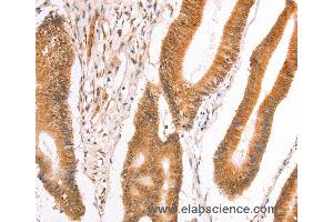 Immunohistochemistry of Human thyroid cancer using TAX1BP1 Polyclonal Antibody at dilution of 1:40