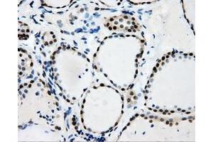 Immunohistochemical staining of paraffin-embedded Adenocarcinoma of colon tissue using anti-RALBP1mouse monoclonal antibody. (RALBP1 Antikörper)