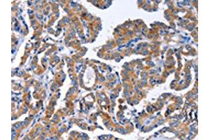 The image on the left is immunohistochemistry of paraffin-embedded Human thyroid cancer tissue using ABIN7129821(IGSF10 Antibody) at dilution 1/50, on the right is treated with fusion protein. (IGSF1 Antikörper)