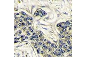 IHC analysis of FFPE human breast carcinoma stained with PI3KCA antibody