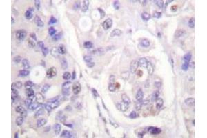 Immunohistochemical analysis of human breast carcinoma tissue (Formalin- fixed Paraffin-embedded) using CDC16 / APC6 antibody . (CDC16 Antikörper)