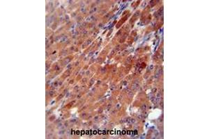 CES2 antibody (Center) immunohistochemistry analysis in formalin fixed and paraffin embedded human hepatocarcinoma followed by peroxidase conjugation of the secondary antibody and DAB staining. (CES2 Antikörper  (Middle Region))