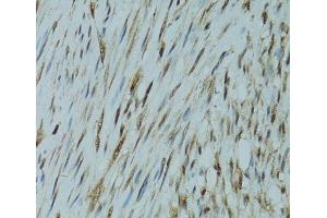 Immunohistochemistry of paraffin-embedded Human uterine cancer using GABPA Polyclonal Antibody at dilution of 1:100 (40x lens). (GABPA Antikörper)