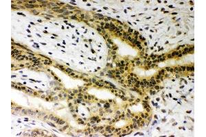 Anti-SIRT6Picoband antibody, (ABIN3043435), IHC(P)IHC(P): Human Mammary Cancer Tissue